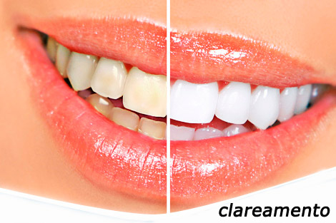 Clareamento dental